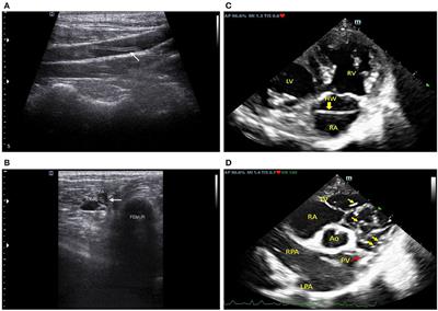 Case report: Thromboembolic heartworm induced lower limb necrosis in a dog